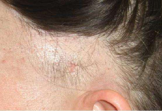 拔毛癖长头发,拔毛癖会拔别人的头发么