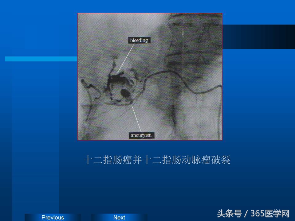 崔进国：消化道出血的介入治疗