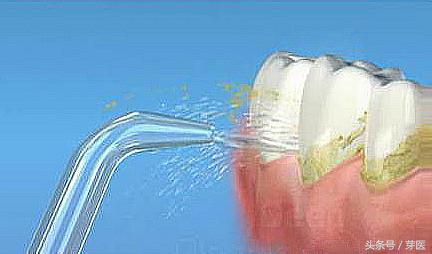洗牙如何避免牙缝变大,闽侯南屿洗牙后牙缝变大
