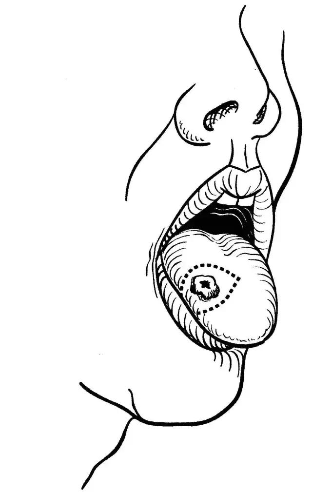 关于舌癌的新闻又一次刷屏，我想起了一年前离开的那位老人