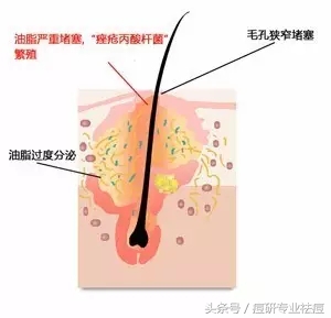 姨妈痘是什么原因,姨妈痘一般长在哪