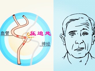 左眼皮跳与神经官能症有关系吗,平时左眼皮跳就会发生不好的事