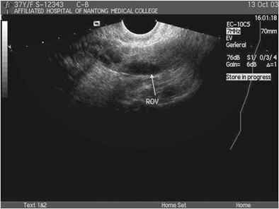 卵巢囊肿的b超描述,卵巢生理性囊肿的b超影像