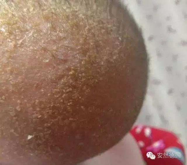 和宝宝湿疹大战,中医看婴幼儿过敏湿疹