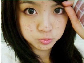 长了痘痘怎么办呀,长了痘痘怎么办学生党