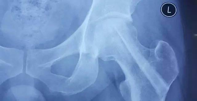 治疗股骨头坏死的微创手术,股骨头坏死的微创治疗