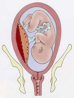 孕妇什么情况下容易发生胎盘早剥,胎盘早剥多少可致胎儿死亡
