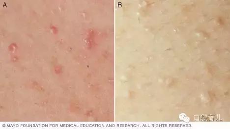 宝宝有痱子用什么方法最有效,宝宝长痱子了用什么方法最好