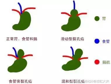 胃病久治不愈是脾虚吗,胃病食管裂孔疝想做手术