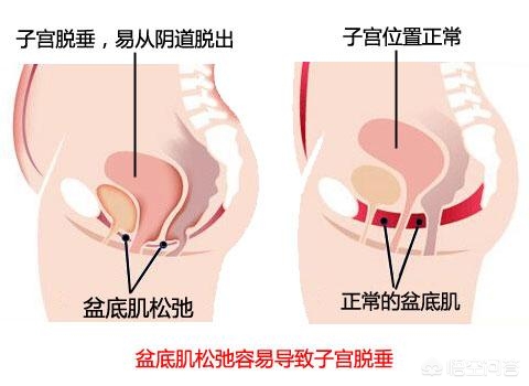 盆底肌肉松弛漏尿的锻炼方法,盆底肌肉松弛漏尿的锻炼方法哑铃