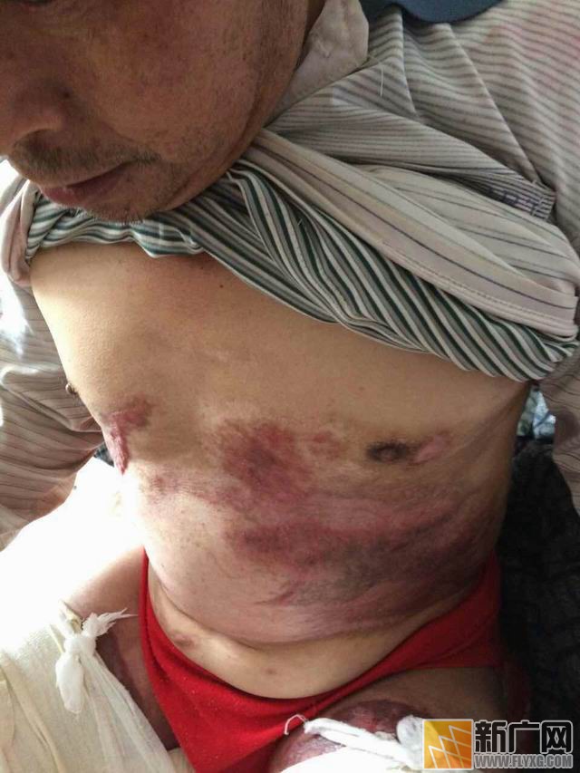 彝族村民李增贵烤贾酒盼脱贫遇火灾，栽多少包谷才能抚平49%烧伤