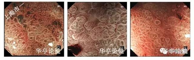 胃小灶癌变,胃体小凹型腺瘤