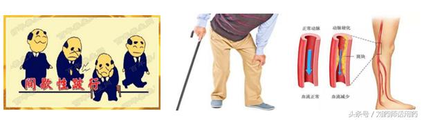 下肢动脉硬化闭塞症用什么方剂,动脉硬化闭塞间歇性跛行怎么治疗