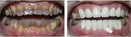 冷光美白牙齿靠谱吗,牙齿美白全过程视频