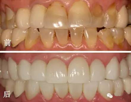 冷光美白牙齿靠谱吗,牙齿美白全过程视频