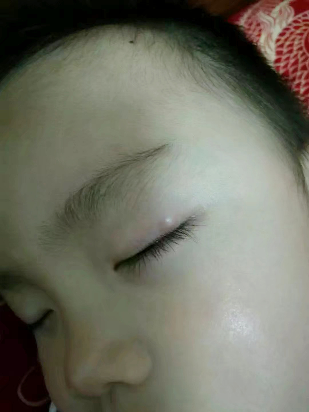 中药摆平霰粒肿经验,孩子得霰粒肿中医怎样调理