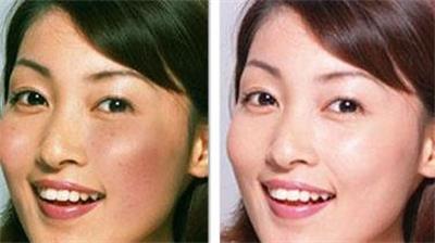 激光祛雀斑好还是药水祛雀斑好,激光祛雀斑哪种激光最好