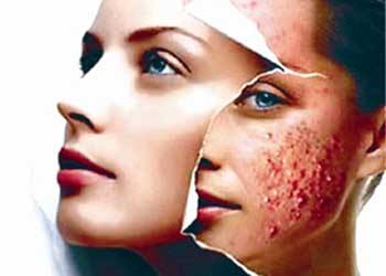 祛痘心酸史真实案例,那些年祛痘走过的弯路