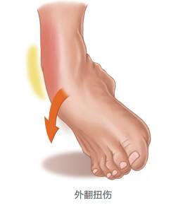脚脖子扭伤没肿胀,脚脖子扭伤叫什么