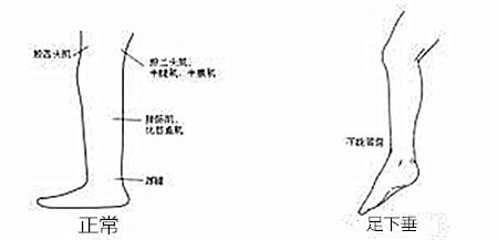 脑瘫康复训练-足下垂该怎么训练？