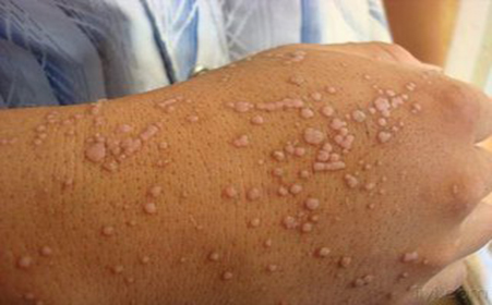 扁平疣和寻常疣和瘊子的区别,寻常疣扁平疣都是瘊子吗