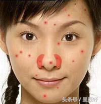 关于痘痘肌肤应该如何护肤,关于痘痘治疗方法