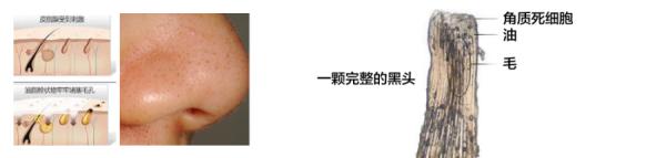 出油黑头毛孔粗大怎么办,毛孔粗大黑头多脸爱出油怎么解决