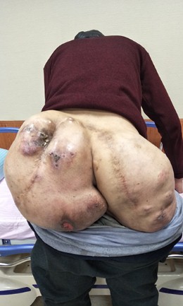 清华长庚多学科切除巨大骶骨脊索瘤让老人甩掉26.3斤巨臀