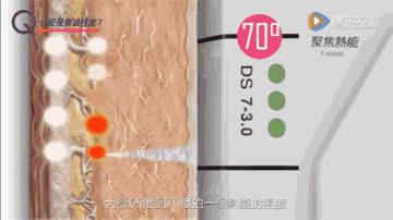 超声刀做脖子,脖子做超声刀术后保养