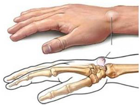 身上长小肉疙瘩有啥危害,身上长了小肉疙瘩能治愈吗