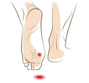 医院治不好鸡眼,发现鸡眼怎么治