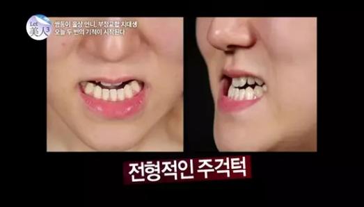 韩国整容手术恢复过程,韩国一个整容的综艺节目