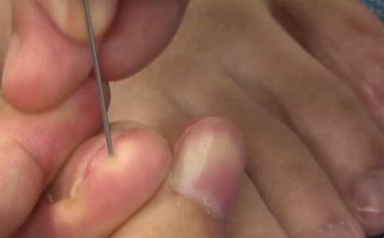 老人突发脑溢血医生急救,怎样急救脑溢血突发的病人