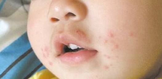 过敏性湿疹应该多吃什么水果,过敏性体质有哪几种水果要少吃