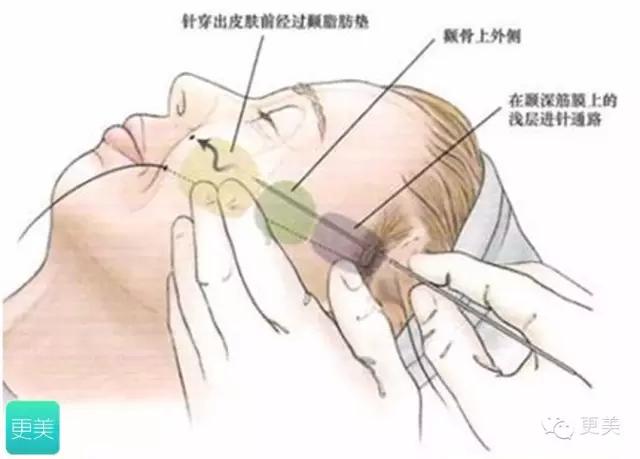 青春定格？4D埋线？音波拉皮？别晕，面部提升就那老三样