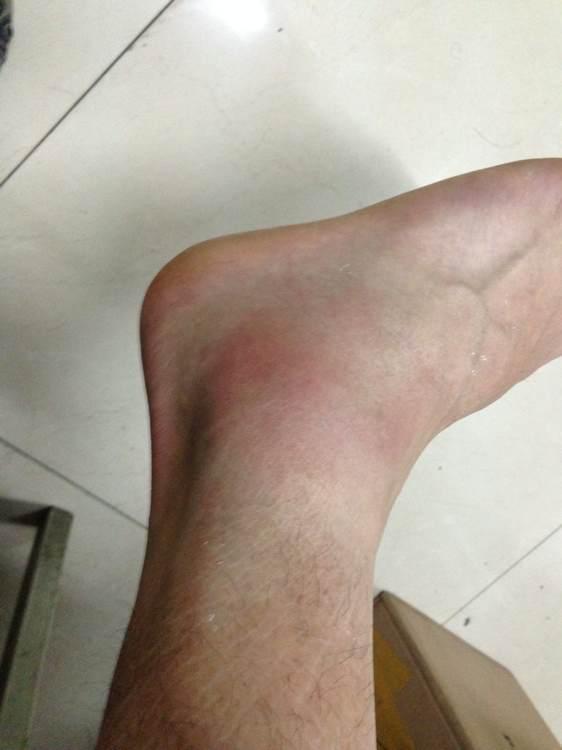 踝部扭伤正确的处理方法,踝关节扭伤应该如何正确处理