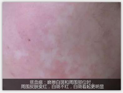 白癜风诊断及鉴别诊断,白癜风的鉴别与诊断