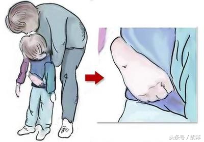 异物呛入气管的急救,呛到气管里异物急救法