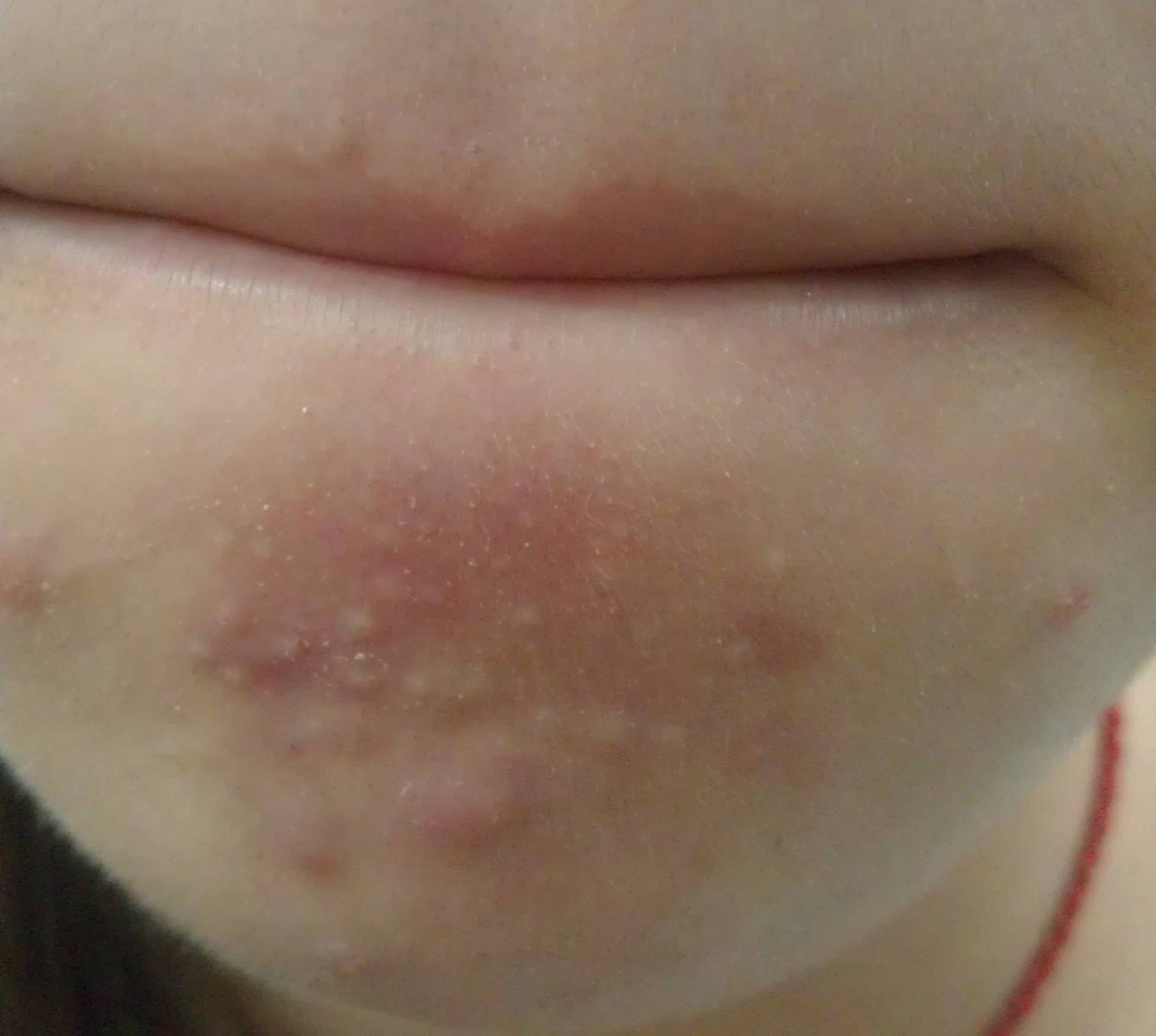 下巴有肉刺是什么病,下巴下面长很多小白点像白粉刺