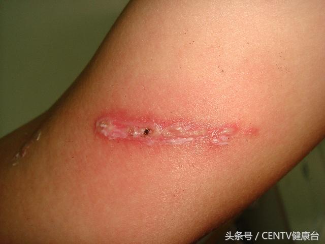 密密麻麻的飞虫怎么治,生活知识隐翅虫有毒切勿直接拍打