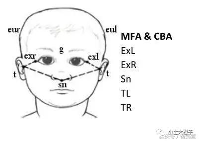 美国的宝宝扁头为什么要矫正,扁头在国外要做矫正吗