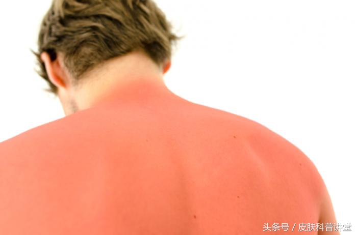 海滩玩的时间长把皮肤晒伤怎么办,皮肤晒伤但是要出门怎么保护