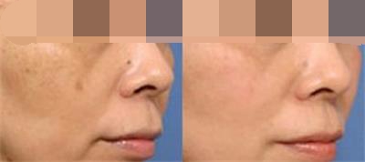 老年斑是怎么形成的如何消除,怎样预防老年斑及去除老年斑