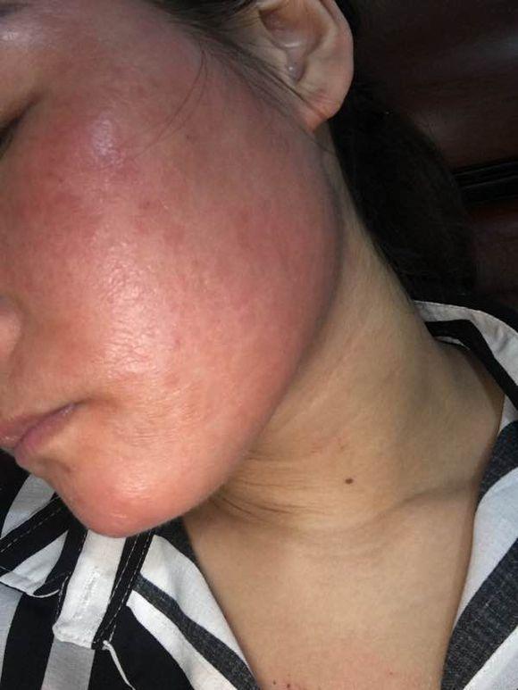 激素脸泛红发烫怎么办,激素脸发红发烫用什么药擦