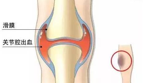 血友病，这些常见问题急需解决办法！