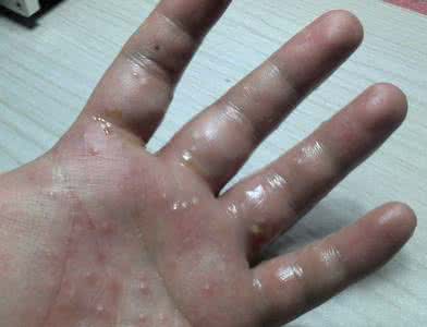 皮肤瘙痒脱皮是什么原因,双手瘙痒是什么原因引起的