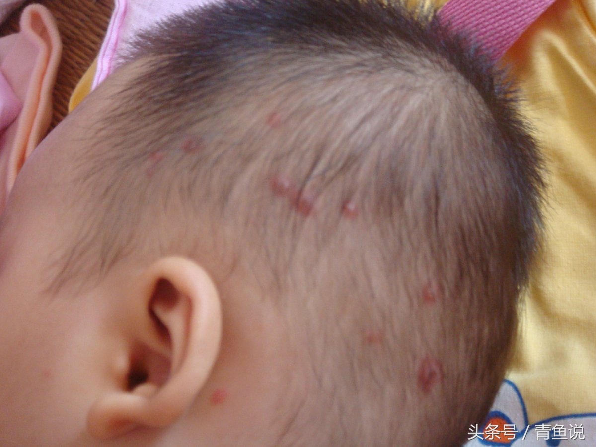 颈部有红疹子用什么药好得快,婴儿颈部红斑是怎么回事