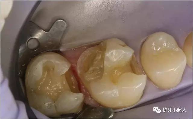 补牙全过程的五个步骤详解,补牙一般需要几步完成