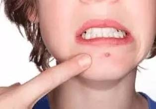 嘴下巴反复长痘是什么原因引起的,中年女人下巴反复长痘是什么原因