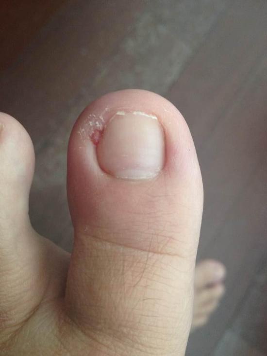 脚趾甲往肉里长很痒怎么办,大拇脚趾肉里痒怎么办